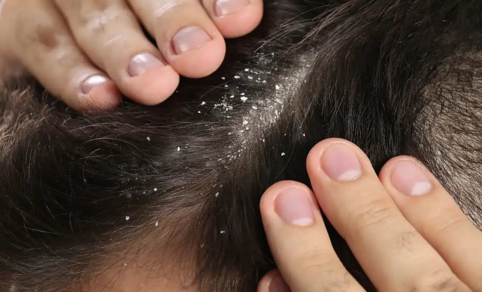 The End of your Dandruff